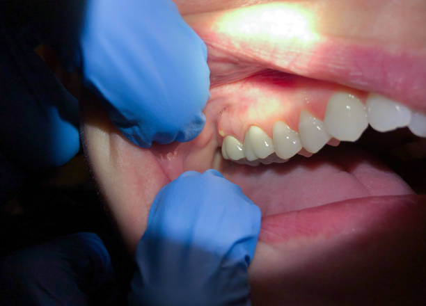 Best Emergency Root Canal Treatment in Owings Mills, MD
